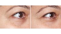 before and after perricone MD